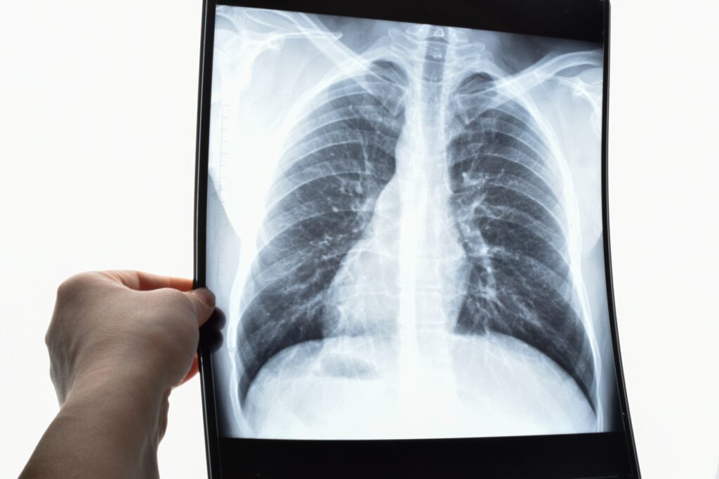 Lung X-ray.